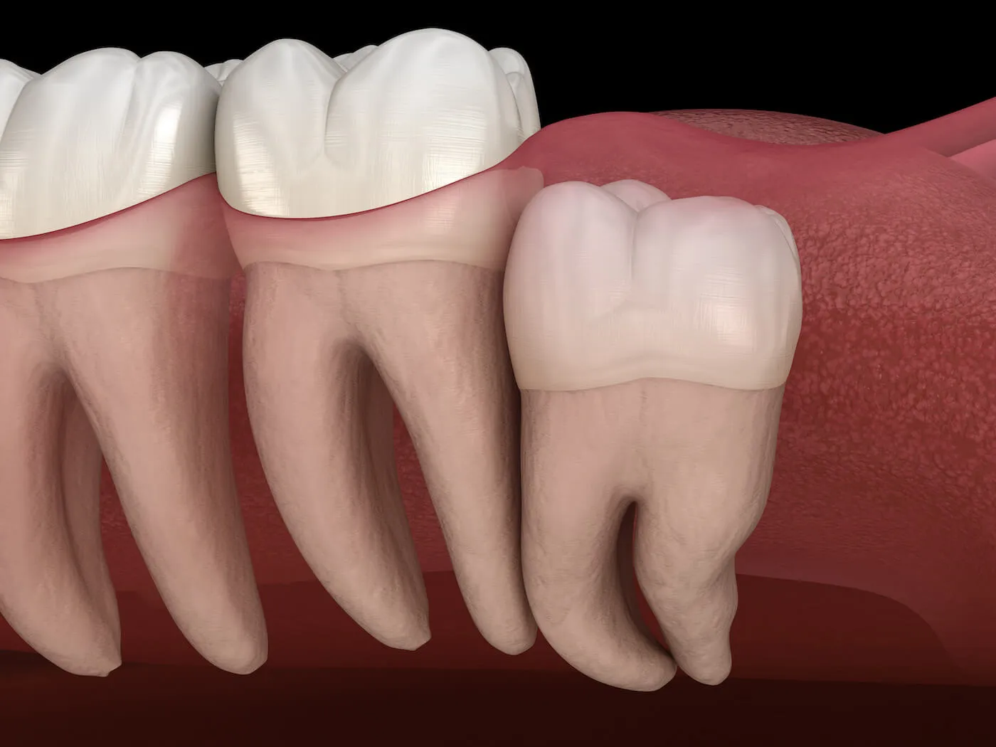 Wisdom Teeth Removal in Parker, AZ | Parker Dental Center